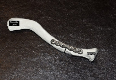 Bone-Fixation-Plate-for-Clavicular-Reduction-Osteotomies-Dr-Barry-Eppley-Indianapolis-768x532.jpg